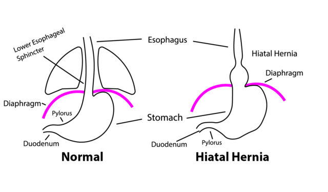 Illustration of hiatal hernia