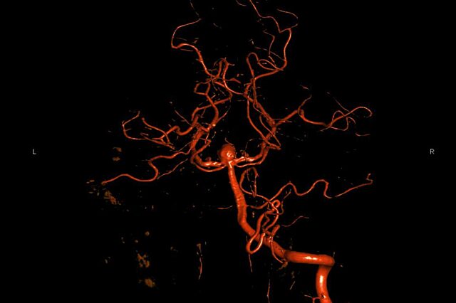 3D image of a Brain Aneurysm