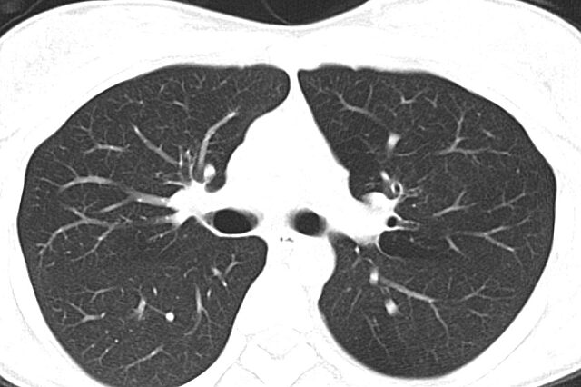 Low dose lung cancer screening with lung nodules