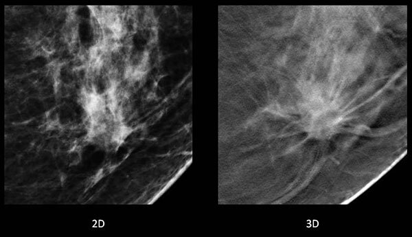2D vs. 3D breast imaging