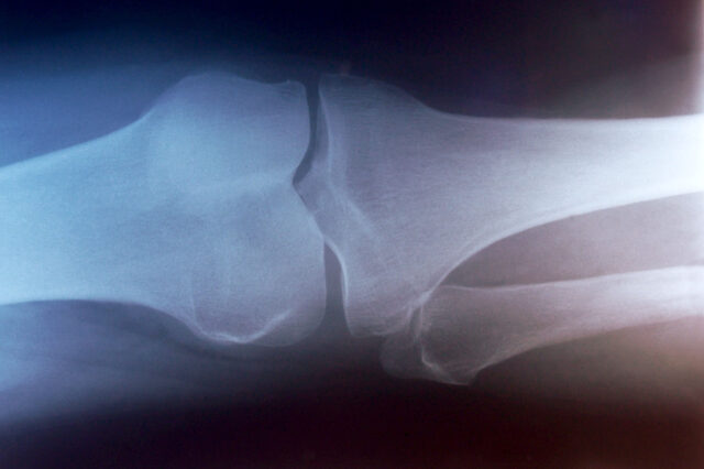 X-ray of a knee joint