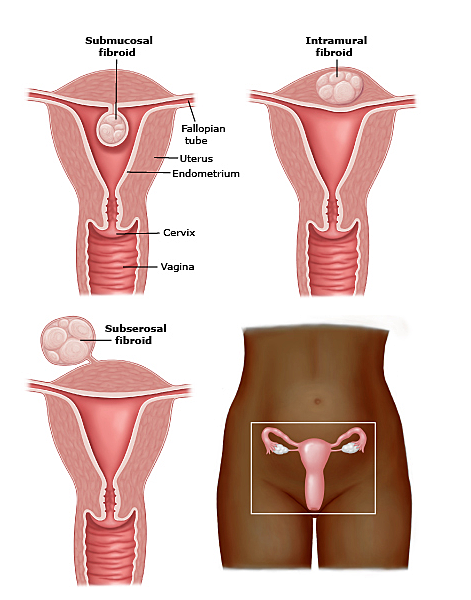 Diagrams of uterine fibroids