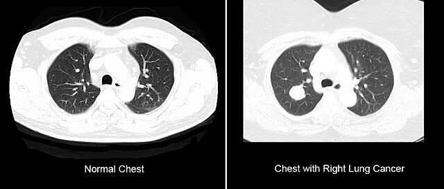CT images comparing lungs with and without lung cancer
